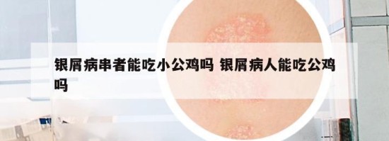 银屑病串者能吃小公鸡吗 银屑病人能吃公鸡吗