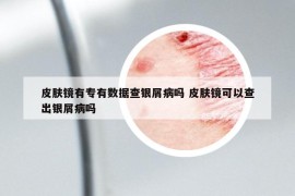 皮肤镜有专有数据查银屑病吗 皮肤镜可以查出银屑病吗