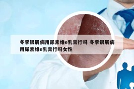 冬季银屑病用尿素维e乳膏行吗 冬季银屑病用尿素维e乳膏行吗女性