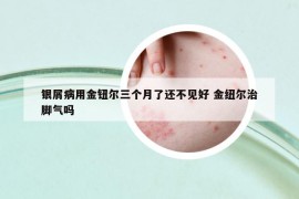 银屑病用金钮尔三个月了还不见好 金纽尔治脚气吗