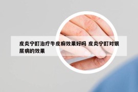 皮炎宁酊治疗牛皮癣效果好吗 皮炎宁酊对银屑病的效果