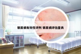 银屑病有效性评判 银屑病评估量表