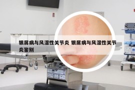 银屑病与风湿性关节炎 银屑病与风湿性关节炎鉴别