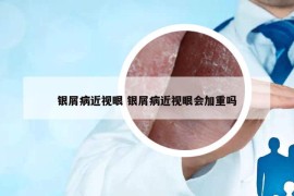 银屑病近视眼 银屑病近视眼会加重吗
