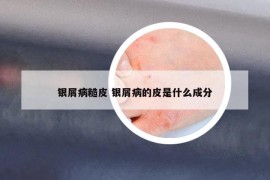 银屑病糙皮 银屑病的皮是什么成分