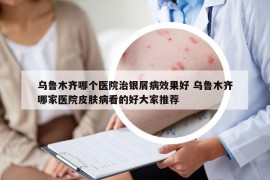 乌鲁木齐哪个医院治银屑病效果好 乌鲁木齐哪家医院皮肤病看的好大家推荐