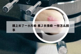 腰上长了一小片癣 腰上长像癣 一样怎么回事