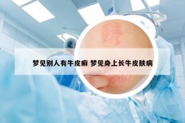 梦见别人有牛皮癣 梦见身上长牛皮肤病