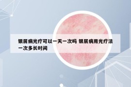 银屑病光疗可以一天一次吗 银屑病用光疗法一次多长时间