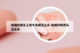 拍婚纱照头上有牛皮癣怎么办 拍婚纱照秃头怎么办