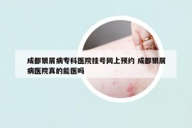 成都银屑病专科医院挂号网上预约 成都银屑病医院真的能医吗