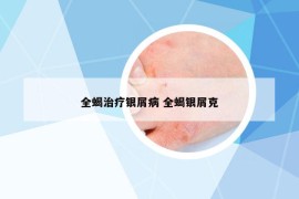 全蝎治疗银屑病 全蝎银屑克