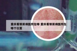 重庆看银屑病医院在哪 重庆看银屑病医院在哪个位置