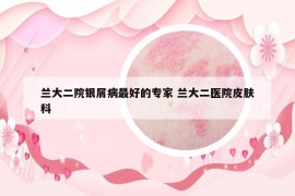 兰大二院银屑病最好的专家 兰大二医院皮肤科