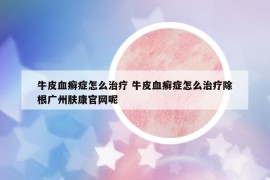 牛皮血癣症怎么治疗 牛皮血癣症怎么治疗除根广州肤康官网呢