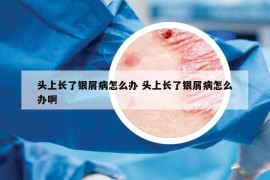 头上长了银屑病怎么办 头上长了银屑病怎么办啊