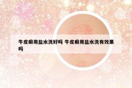 牛皮癣用盐水洗好吗 牛皮癣用盐水洗有效果吗