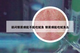 请问银屑病能不能吃鱿鱼 银屑病能吃鱿鱼么