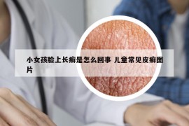 小女孩脸上长癣是怎么回事 儿童常见皮癣图片