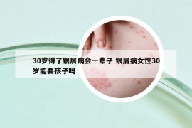 30岁得了银屑病会一辈子 银屑病女性30岁能要孩子吗