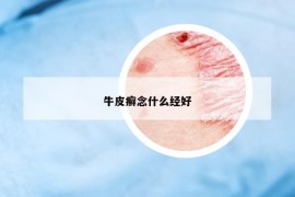 牛皮癣念什么经好