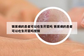 银屑病的患者可以吃生芹菜吗 银屑病的患者可以吃生芹菜吗视频