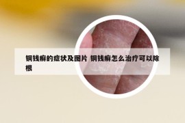 铜钱癣的症状及图片 铜钱癣怎么治疗可以除根