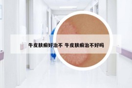 牛皮肤癣好治不 牛皮肤癣治不好吗