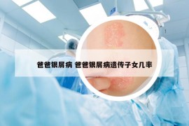 爸爸银屑病 爸爸银屑病遗传子女几率