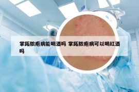 掌跖脓疱病能喝酒吗 掌跖脓疱病可以喝红酒吗