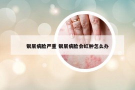 银屑病脸严重 银屑病脸会红肿怎么办
