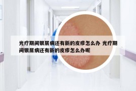 光疗期间银屑病还有新的皮疹怎么办 光疗期间银屑病还有新的皮疹怎么办呢