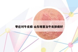 枣庄对牛皮癣 山东哪里治牛皮肤癣好