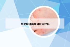 牛皮癣进展期可以治好吗