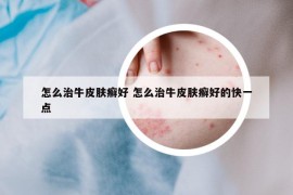 怎么治牛皮肤癣好 怎么治牛皮肤癣好的快一点
