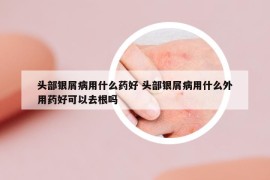 头部银屑病用什么药好 头部银屑病用什么外用药好可以去根吗
