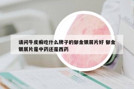 请问牛皮癣吃什么牌子的郁金银屑片好 郁金银屑片是中药还是西药