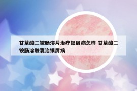 甘草酸二铵肠溶片治疗银屑病怎样 甘草酸二铵肠溶胶囊治银屑病