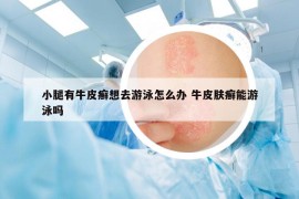 小腿有牛皮癣想去游泳怎么办 牛皮肤癣能游泳吗