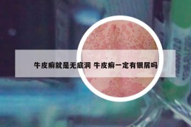 牛皮癣就是无底洞 牛皮癣一定有银屑吗