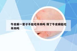 牛皮癣一辈子不能吃羊肉吗 得了牛皮癣能吃羊肉吗