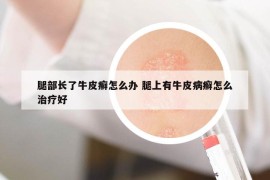 腿部长了牛皮癣怎么办 腿上有牛皮病癣怎么治疗好