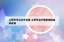 土茯苓可以治牛皮癣 土茯苓治疗银屑病的临床应用