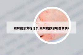 银屑病忌食吃什么 银屑病都忌哪些食物?