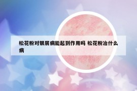 松花粉对银屑病能起到作用吗 松花粉冶什么病