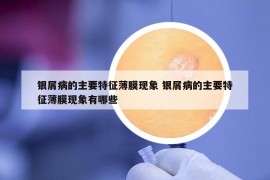 银屑病的主要特征薄膜现象 银屑病的主要特征薄膜现象有哪些