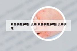 银屑病要多喝什么茶 银屑病要多喝什么茶调理