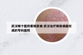 武汉哪个医院看银屑病 武汉治疗银屑病最权威的专科医院