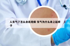 人生气了怎么会出现癣 生气为什么身上起疹子