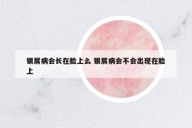 银屑病会长在脸上么 银屑病会不会出现在脸上